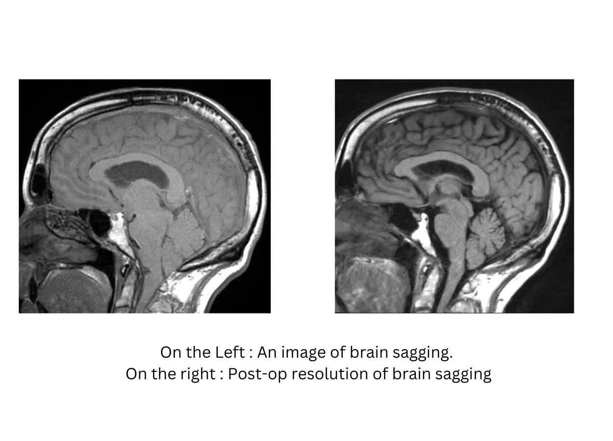 Possible underlying cause of dementia detected