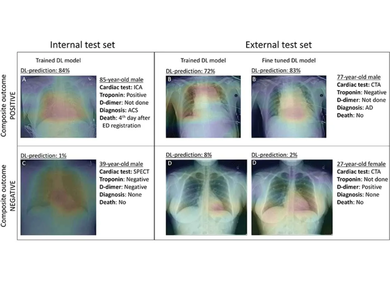 Researchers Use AI to Triage Patients with Chest Pain