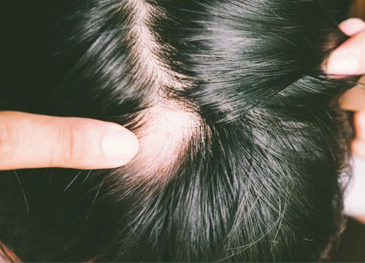 Sun Pharma to acquire Concert Pharmaceuticals, advancing treatment of Alopecia Areata