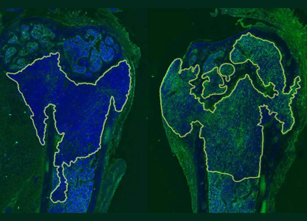 Two-pronged immunotherapy eliminates metastatic breast cancer in mice