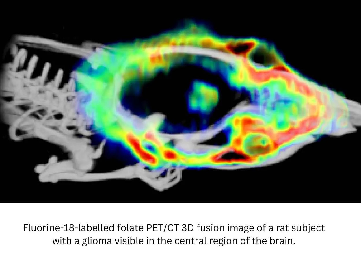 New Discovery Can Help Detect Brain Tumours