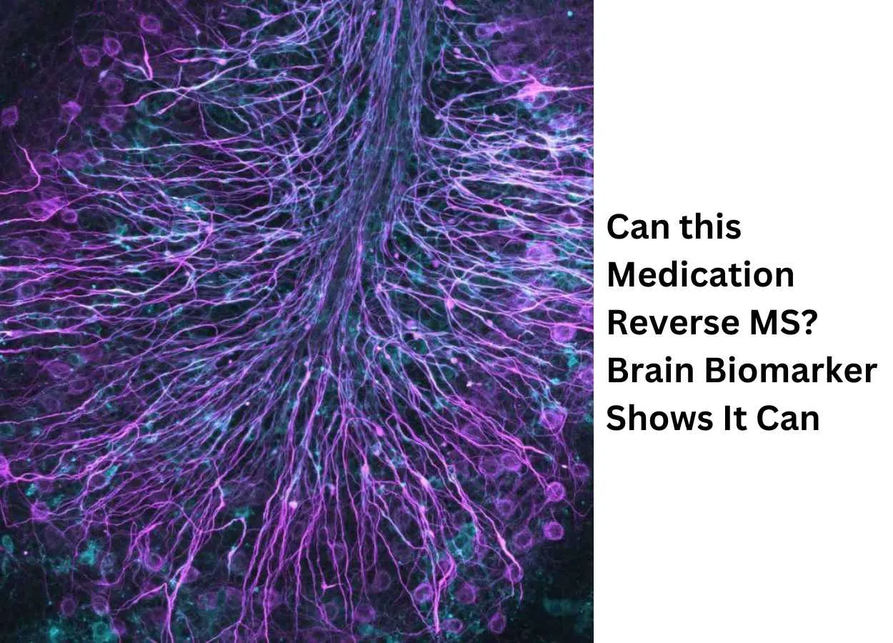 Scientists identified an over-the-counter antihistamine as a treatment for multiple sclerosis