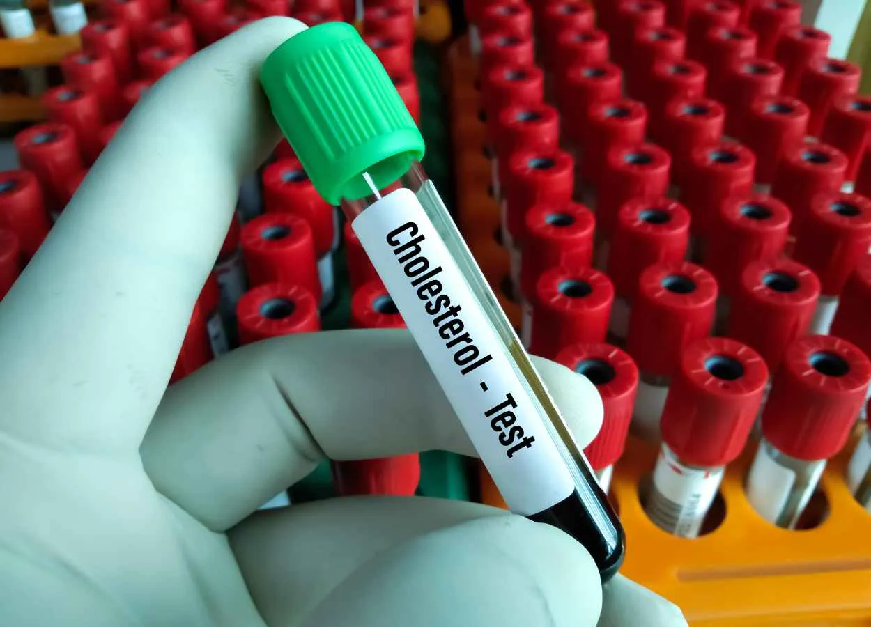 Fluctuating Levels of Cholesterol and Triglycerides Linked to Increased Risk of Dementia