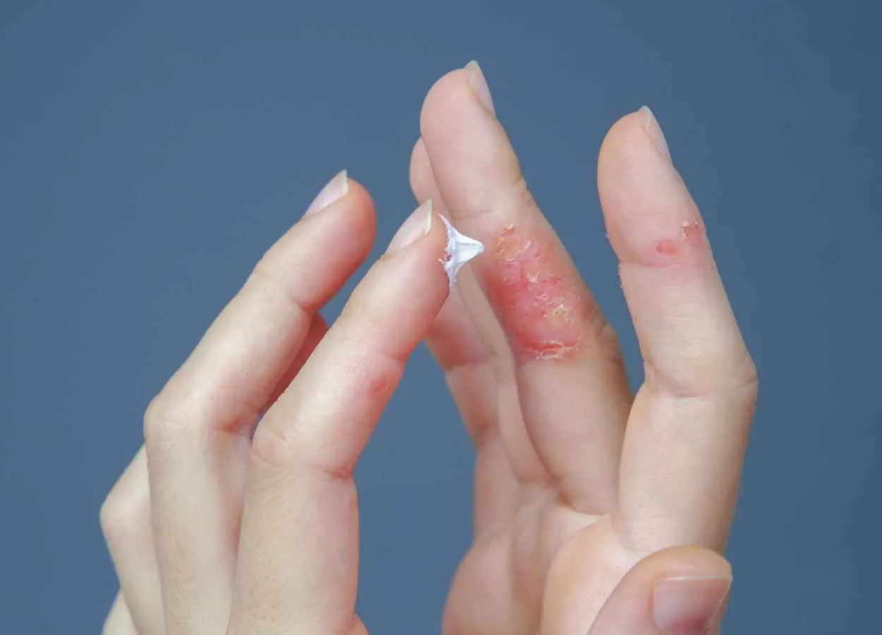 Inflammatory Bowel Disease Linked to Atopic Dermatitis