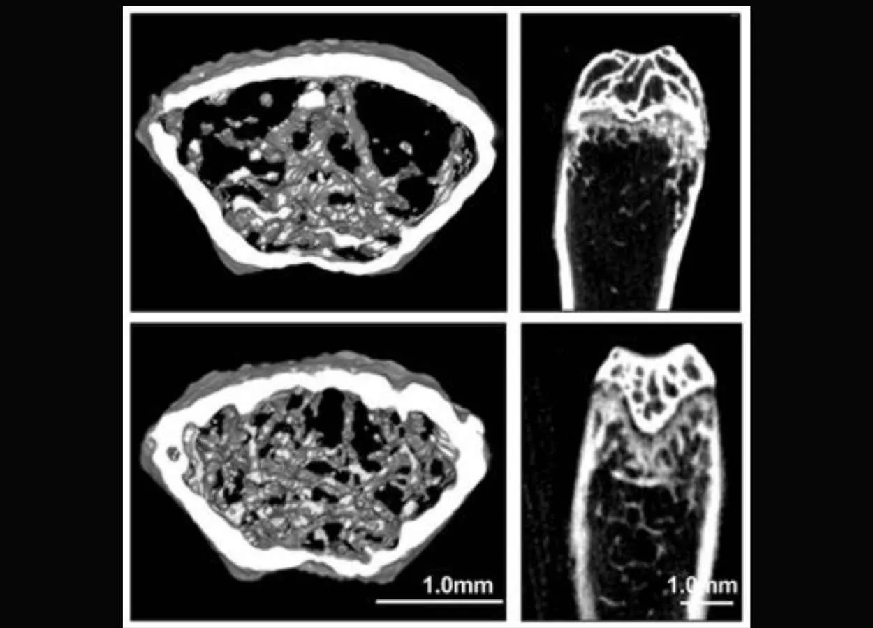 AI identifies antimalarial drug as possible osteoporosis treatment