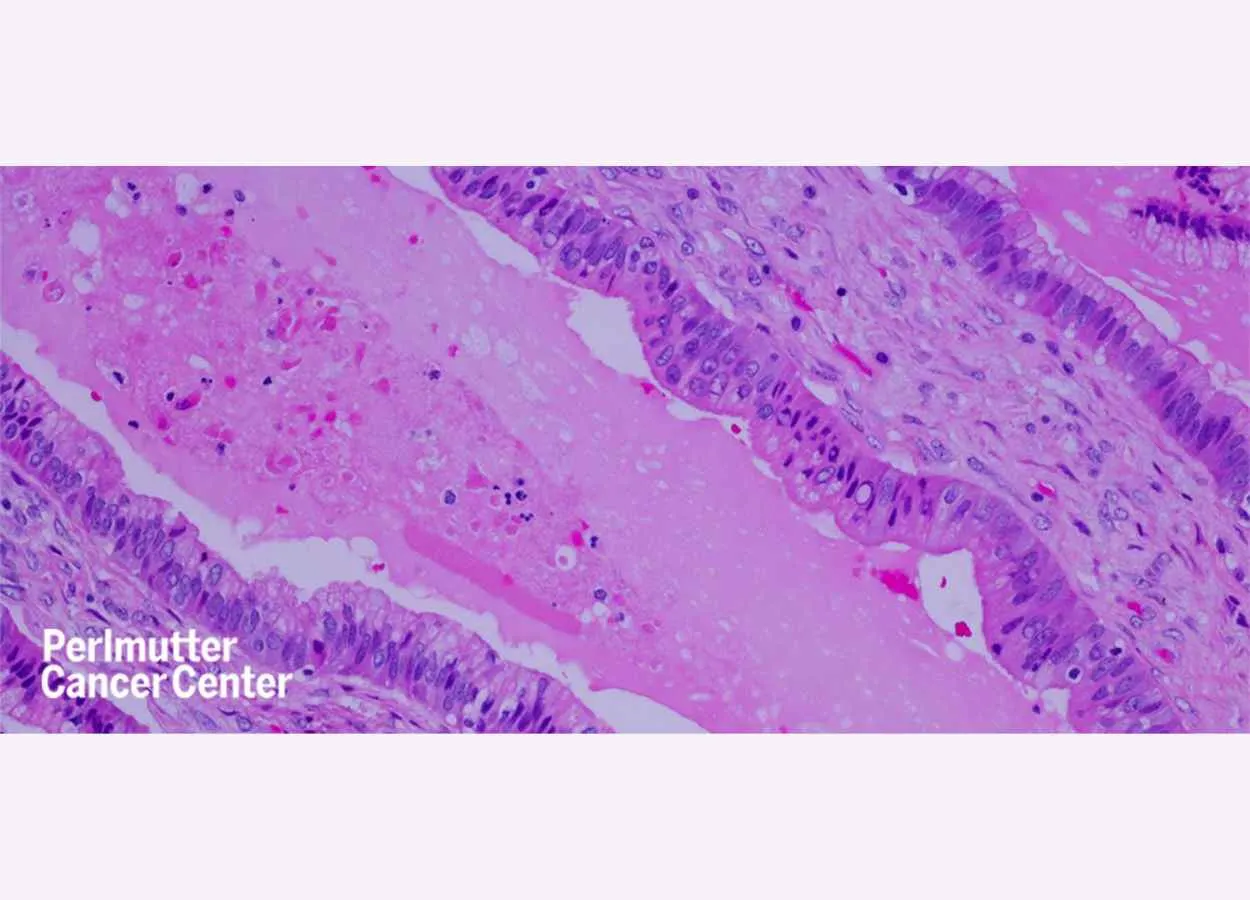 Newfound Mechanism Suggests Drug Combination Could Starve Pancreatic Cancer