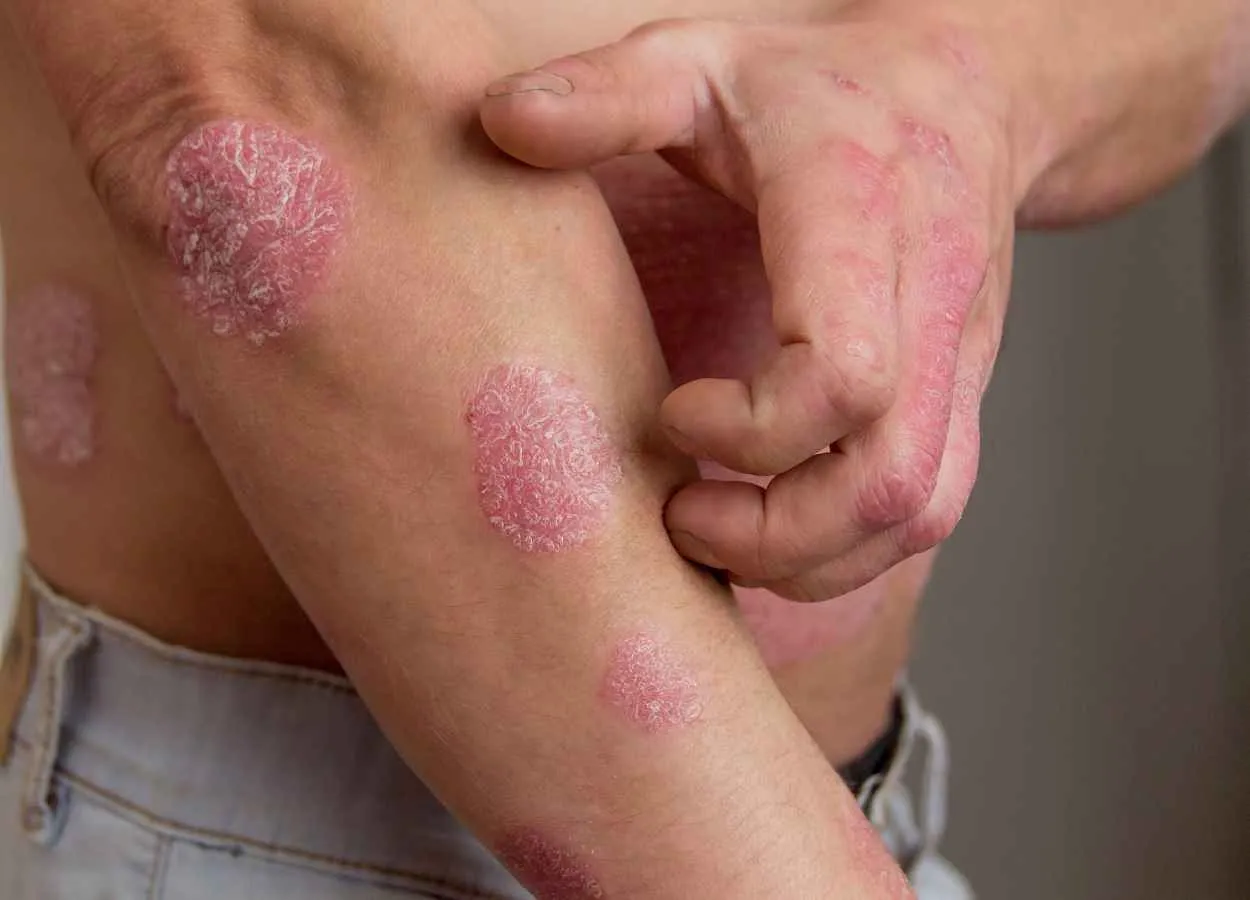 Psoriasis not caused by spontaneous mutations in skin cells