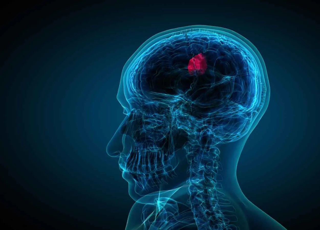 FDA Approves First Therapy for Rare Type of Non-Cancerous Tumors