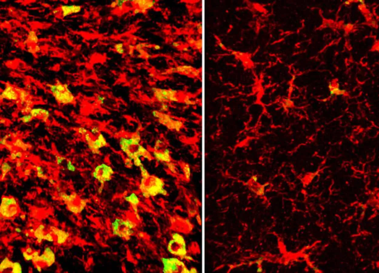 Lowering a form of brain cholesterol reduces Alzheimer’s-like damage in mice