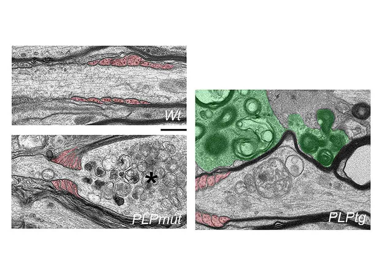 Neurodegeneration in Myelin Disease : No Myelin is Better than Bad Myelin