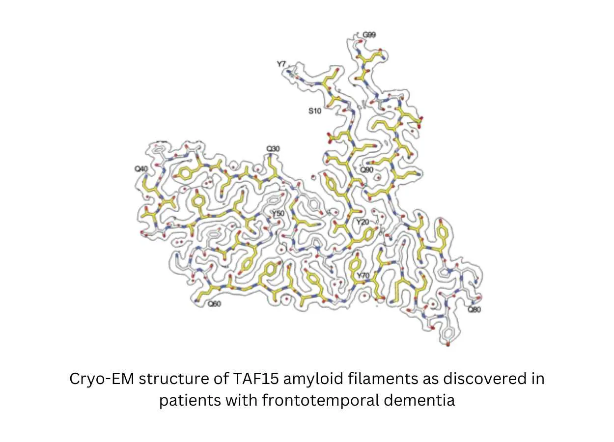 Protein found in brain linked to frontotemporal dementia