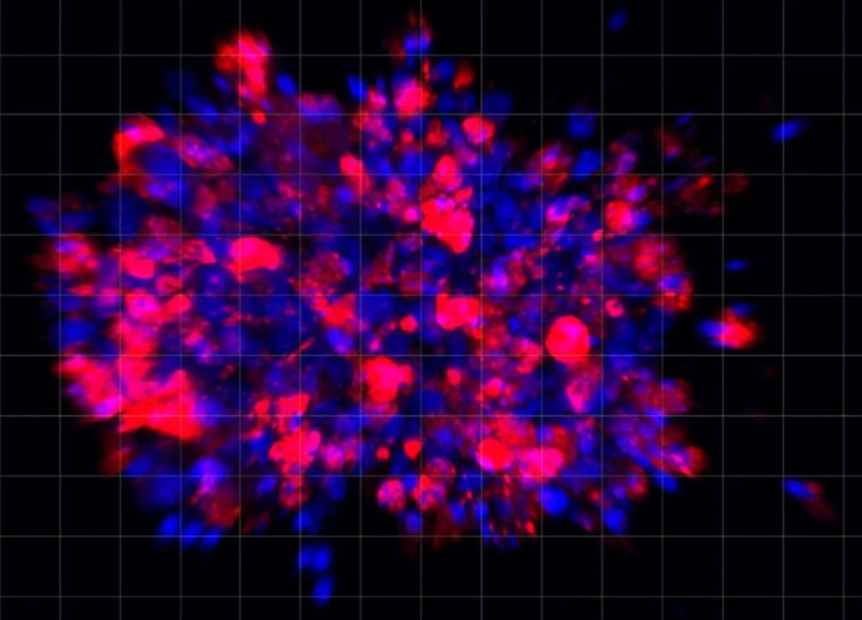 Scientists Use Organoid Model to Identify Potential New Pancreatic Cancer Treatment