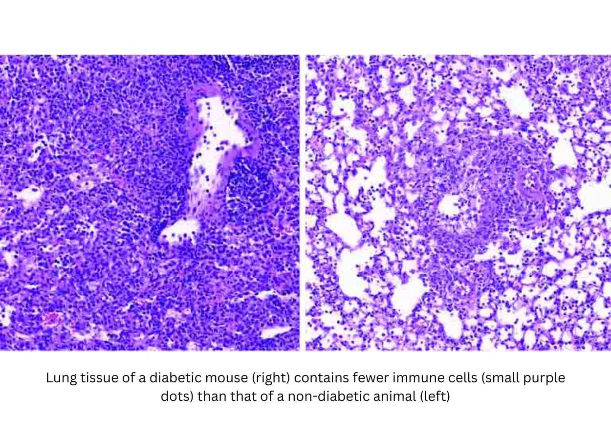 Why People with Diabetes Are More Prone to Respiratory Risk