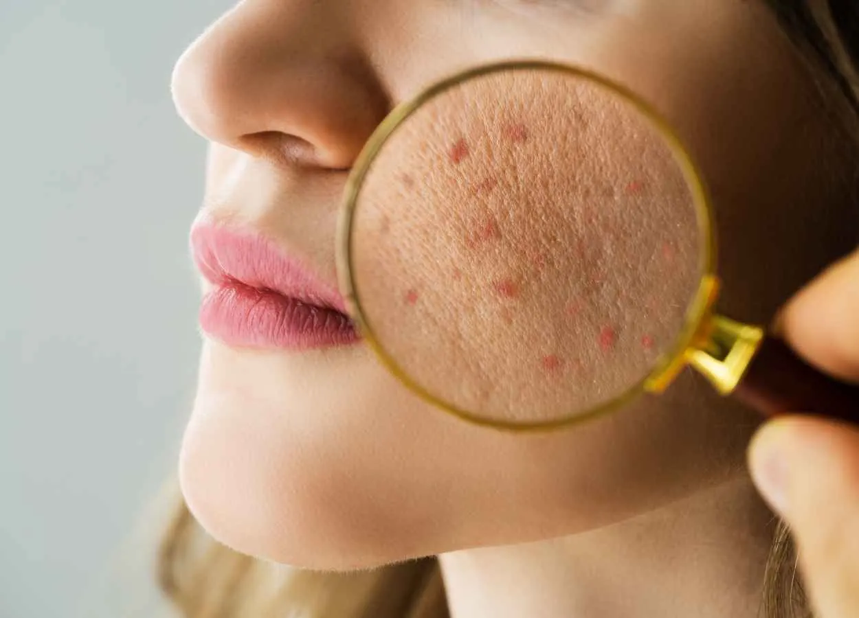 Barrier Repair - A trend in Cosmetics Formulation