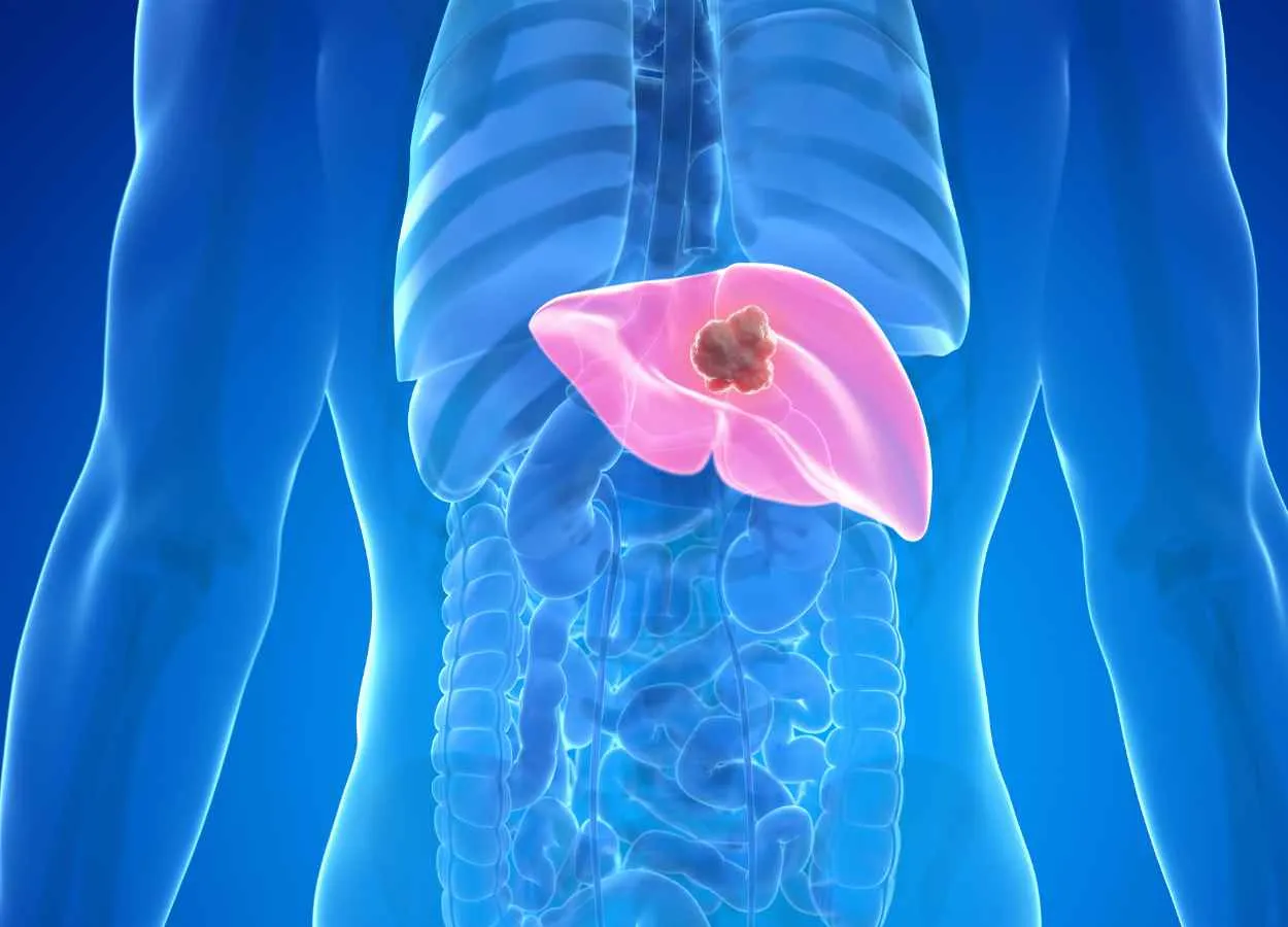 Treating liver cancer with microrobots piloted by a magnetic field