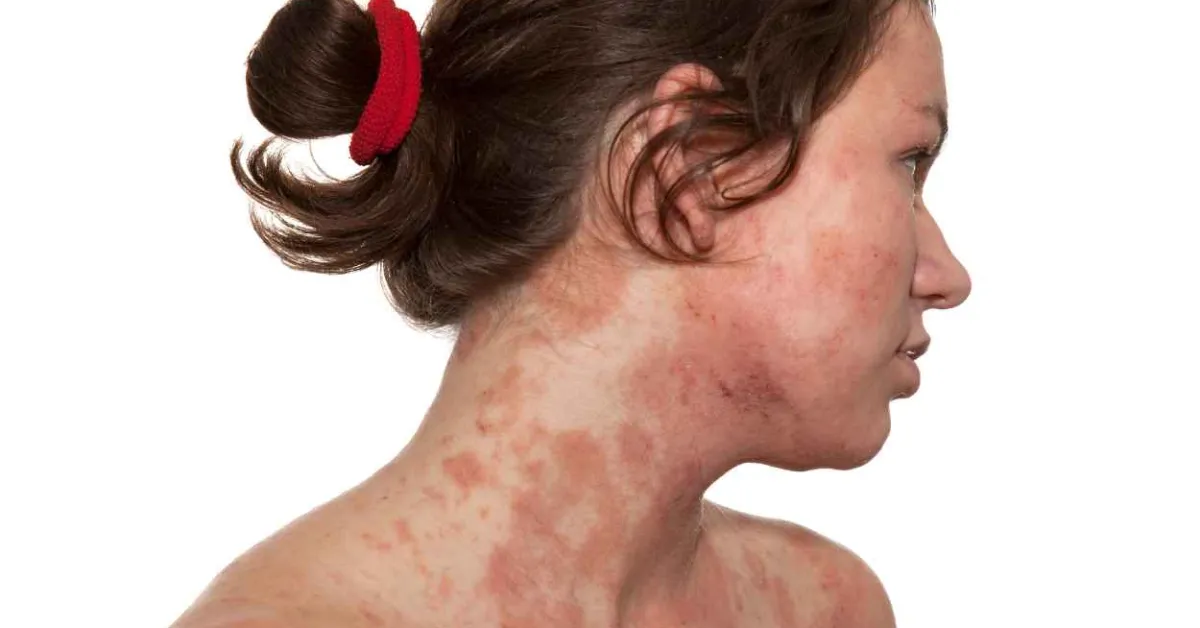 More than two-thirds of people with atopic dermatitis and skin of color experienced skin improvement in a first-of-its-kind lebrikizumab study