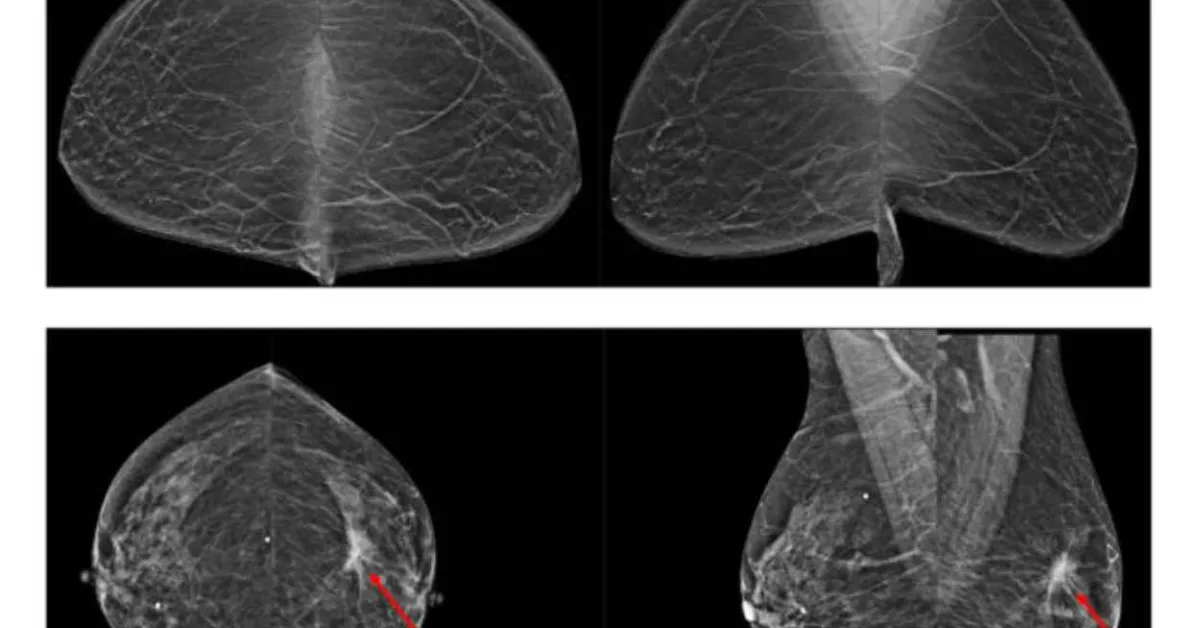 AI-assisted breast-cancer screening may reduce unnecessary testing
