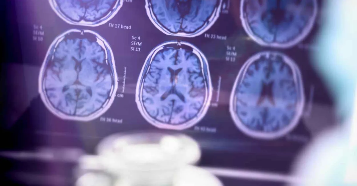 Common HIV treatments may aid Alzheimer’s disease patients
