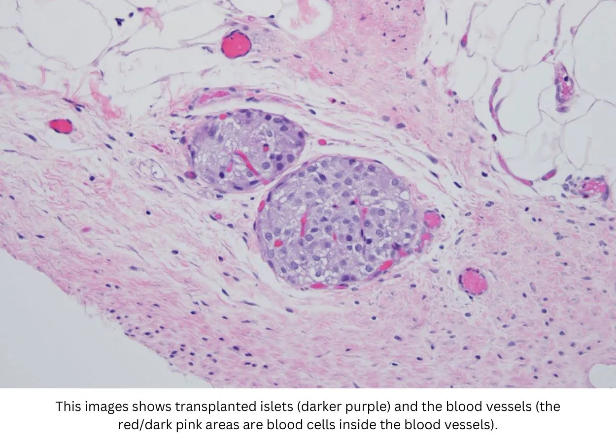 Antioxidant gel preserves islet function after pancreas removal