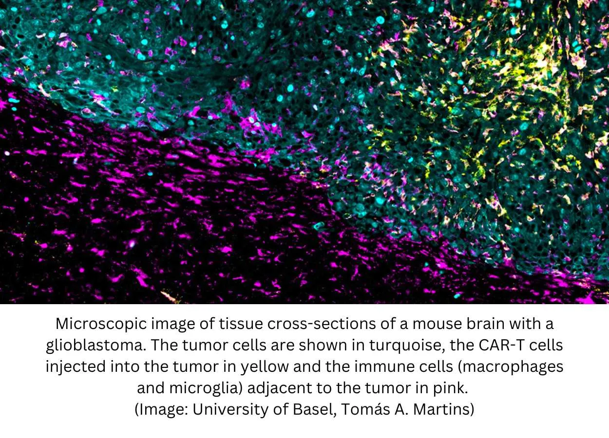 Glioblastoma : new treatment attacks brain tumors from multiple angles | PharmaTutor