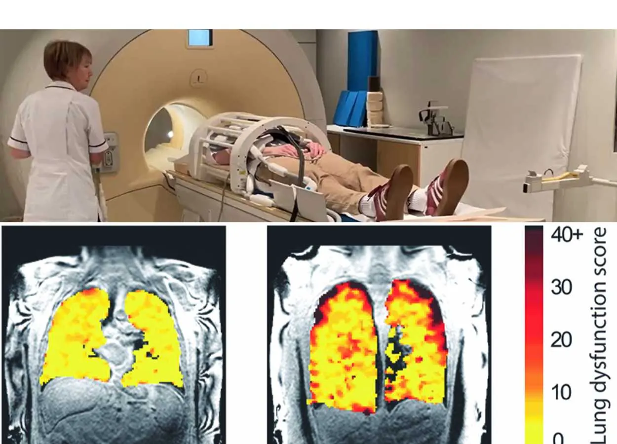 New scan method unveils lung function secrets
