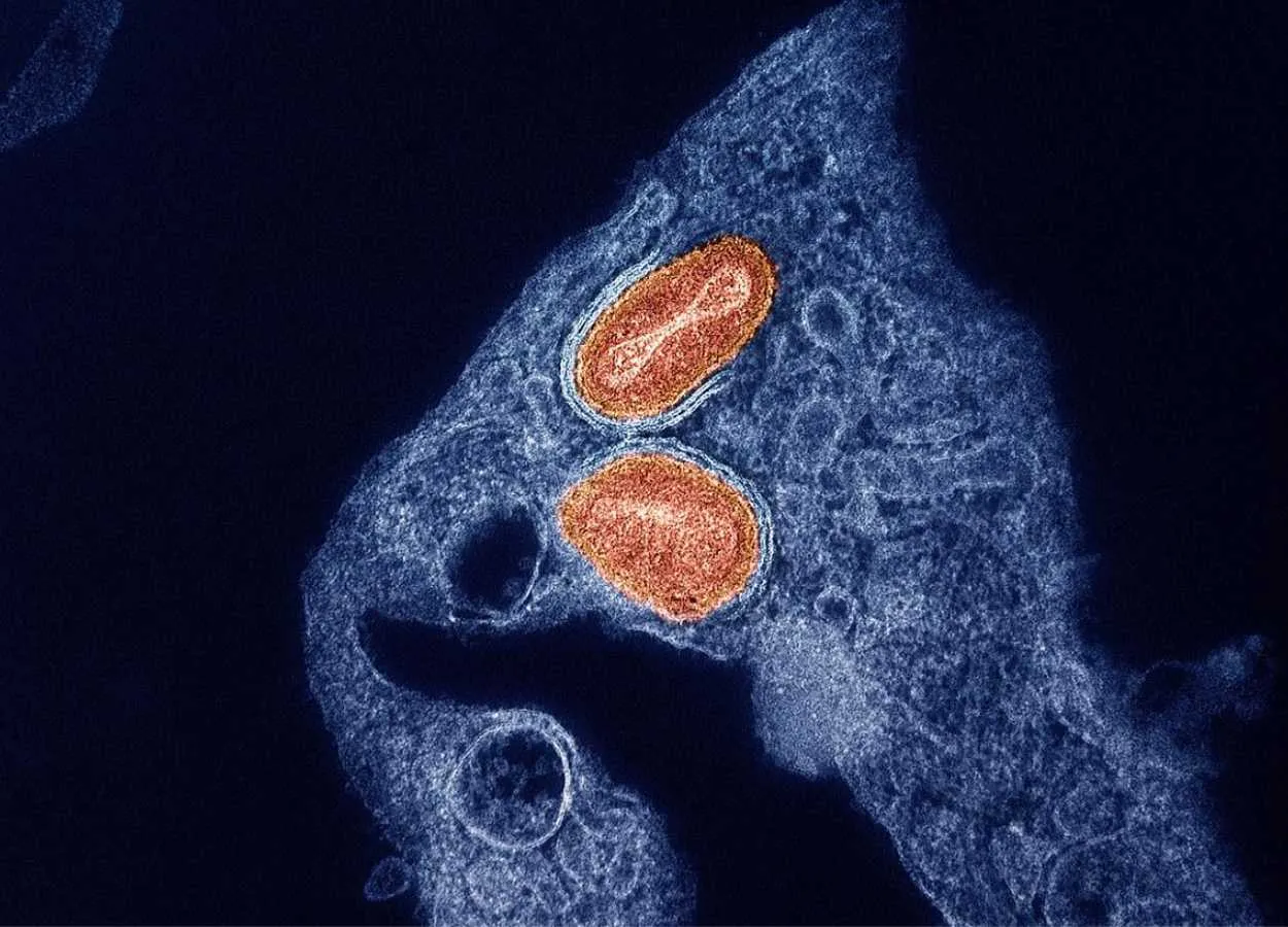 NIH Study Finds Tecovirimat Was Safe but Did Not Improve Mpox Resolution or Pain