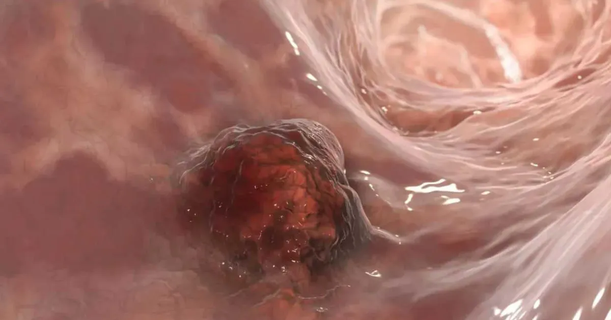 Bacteria leaking across stomach lining could indicate risk of gastric cancer, study finds