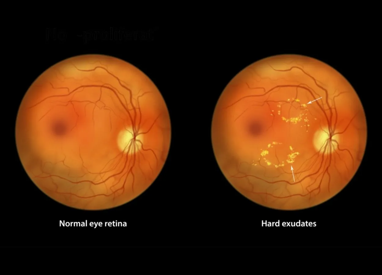 Managing your diabetes can help prevent associated vision loss
