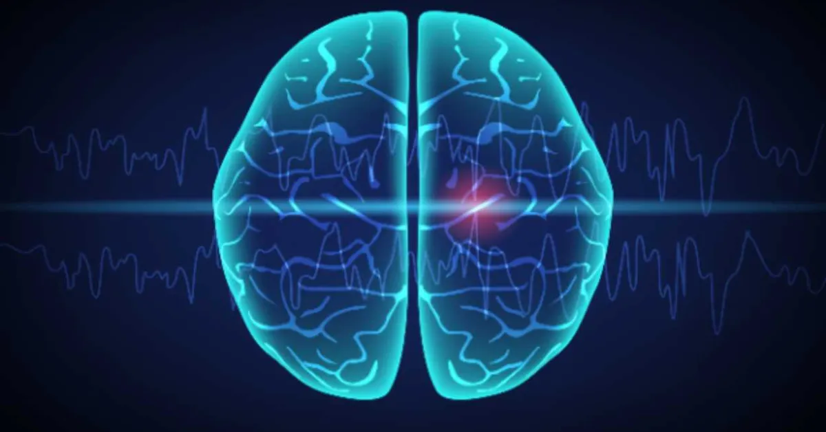 Common genetic variants linked to drug-resistant epilepsy