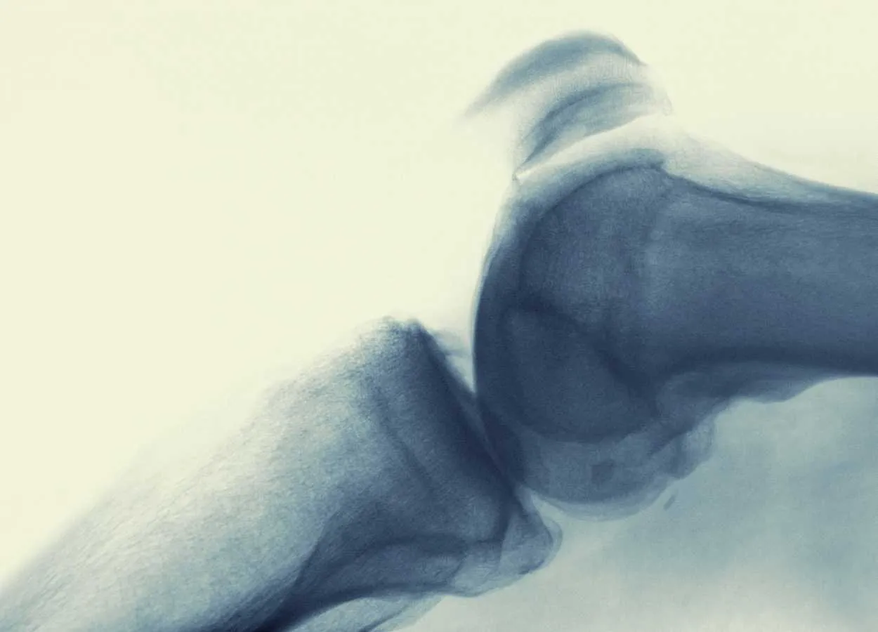 A potential way to relieve arthritic knees without drugs or surgery