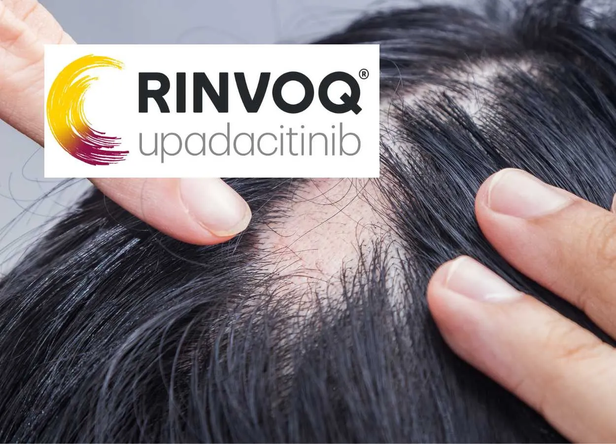 AbbVie RINVOQ Shows Promising Results in Phase 3 Trial for Severe Alopecia Areata