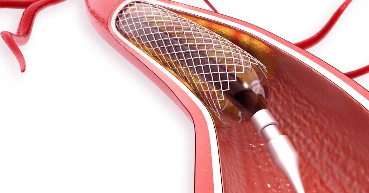 Individuals with diabetes are more likely to suffer complications after stent surgery