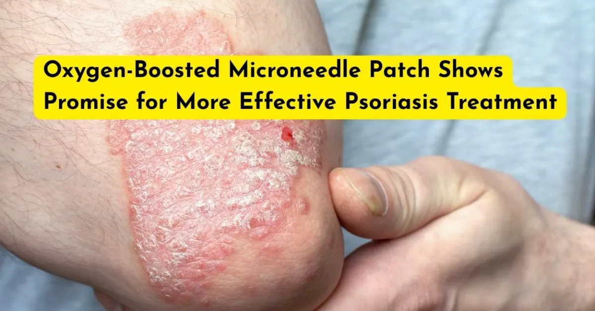 Oxygen-Boosted Microneedle Patch Shows Promise for More Effective Psoriasis Treatment