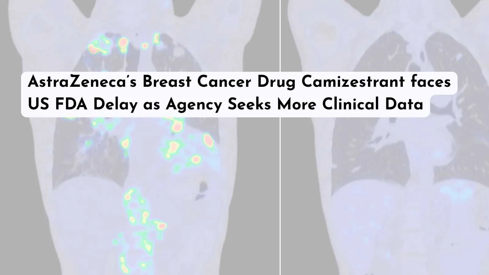 AstraZeneca’s Breast Cancer Drug Camizestrant faces US FDA Delay as Agency Seeks More Clinical Data