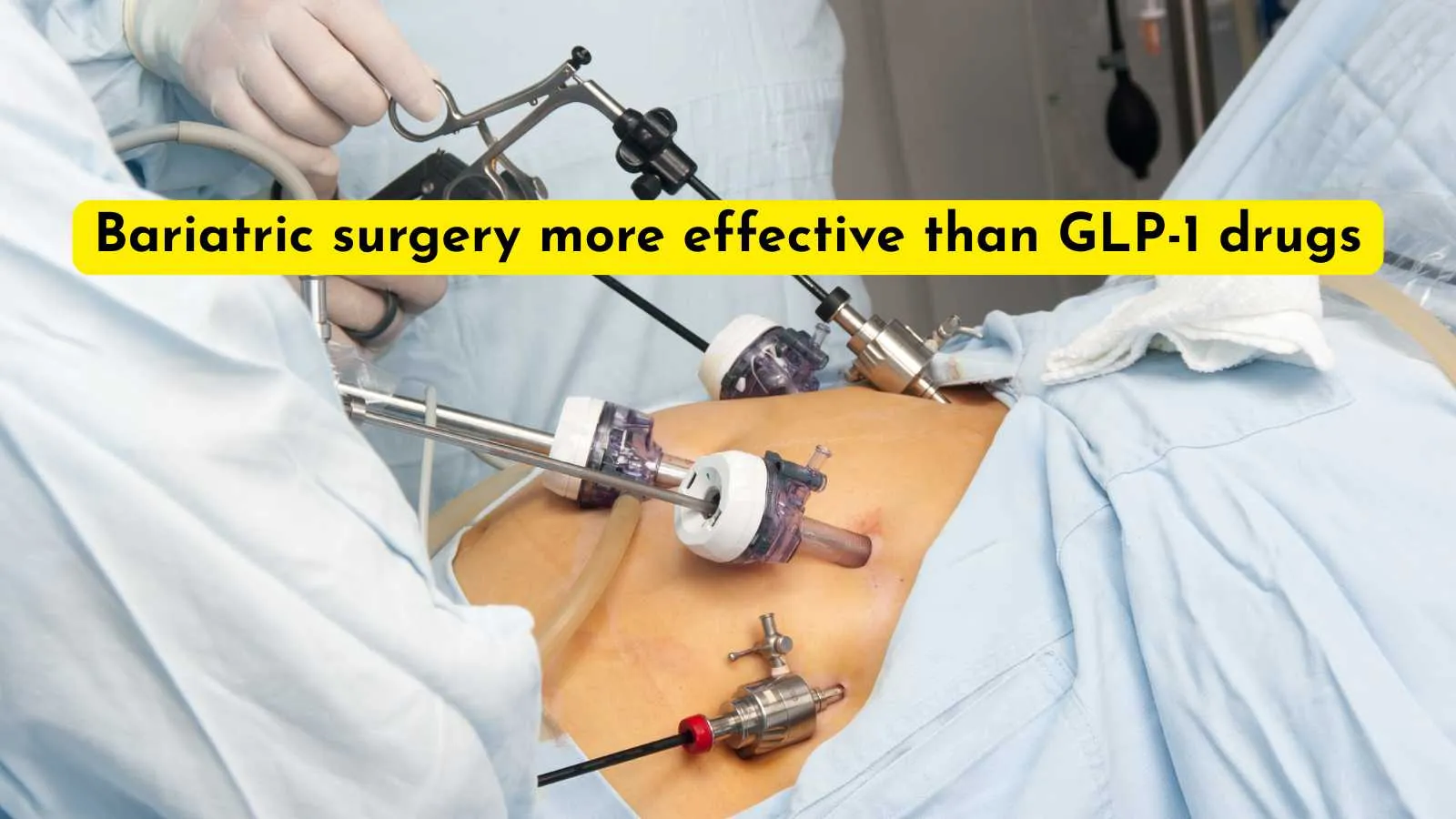 Bariatric surgery more effective than GLP-1 drugs at preventing heart attacks, stroke and death in older adults