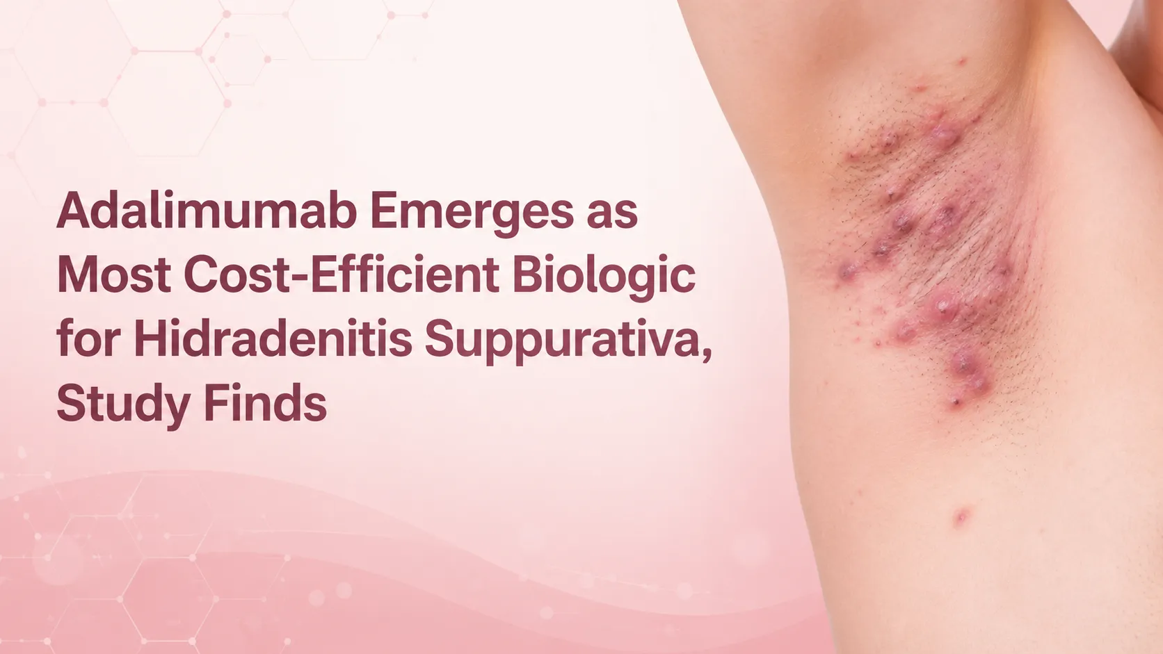 Adalimumab Emerges as Most Cost-Efficient Biologic for Hidradenitis Suppurativa